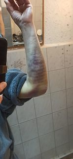 Arm mit großflächigem Hämatom