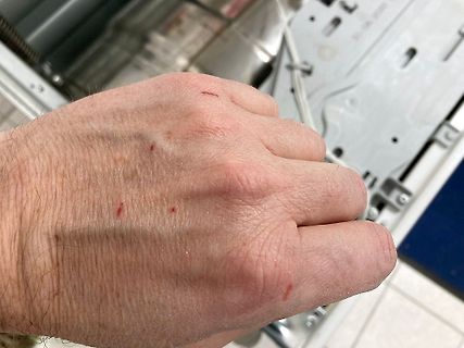 Hand mit kleinen roten Flecken