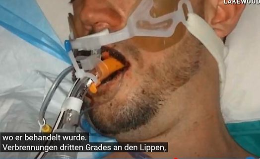 Nahaufnahme einer medizinischen Behandlung am Mund einer Person