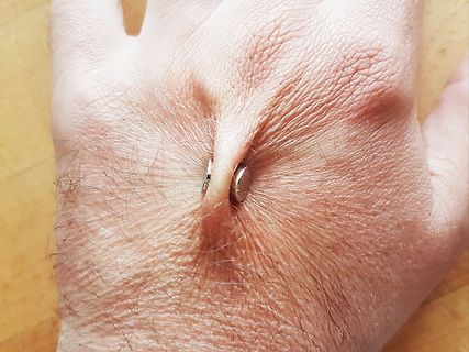 Nahaufnahme einer Hand mit Metallobjekt in der Hautfalte